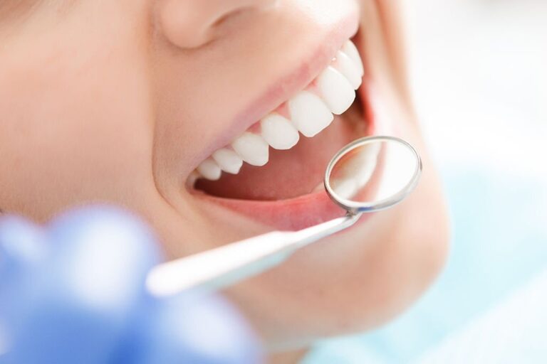 Best Way to Get Rid of White Spots on Teeth