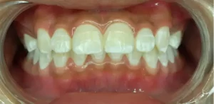 Preventing White Spots on Teeth
