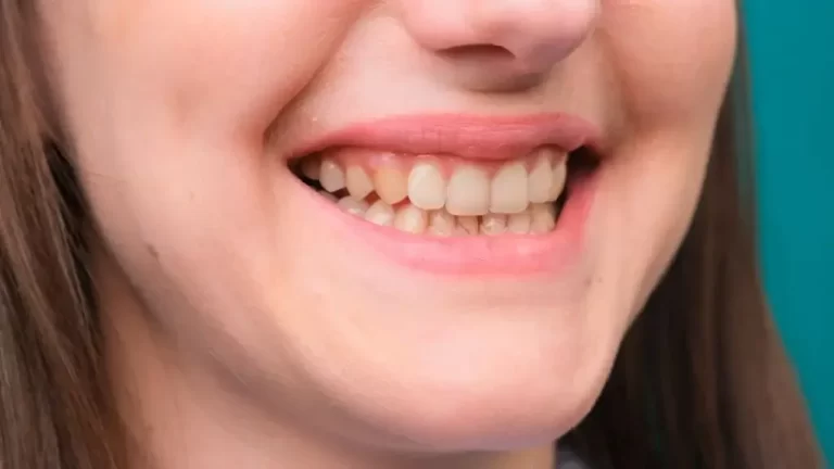 Can White Spots on Teeth Go Away on Their Own?