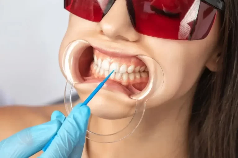 Can Whitening Strips Cause White Spots on Your Teeth?