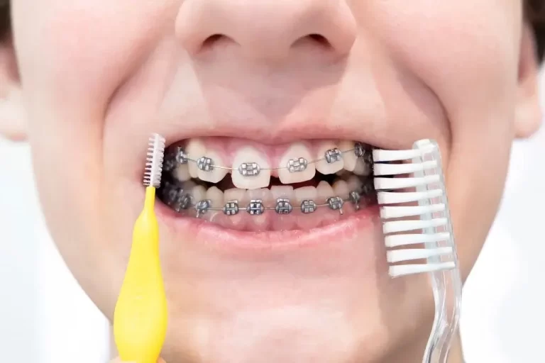 Do White Spots on Teeth From Braces Go Away?