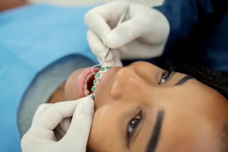 How to Fix White Spots on Teeth After Braces?