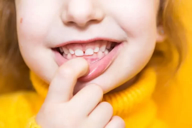 How to Get Rid of White Spots on Baby Teeth