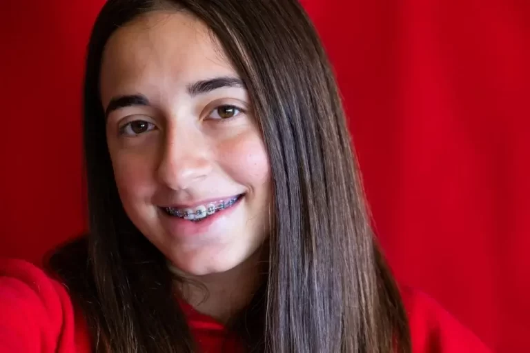 How to Get Rid of White Spots on Teeth from Braces?