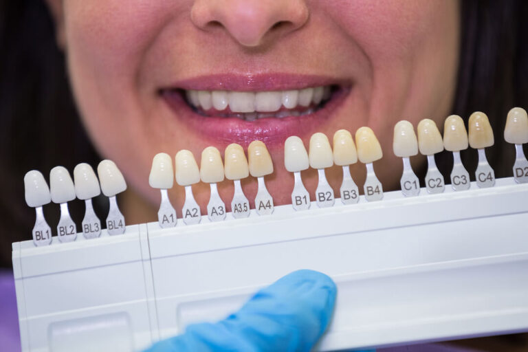 Dental Veneers: A Solution for White Spots on Teeth?